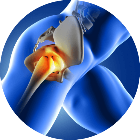 Hip Replacement Surgery